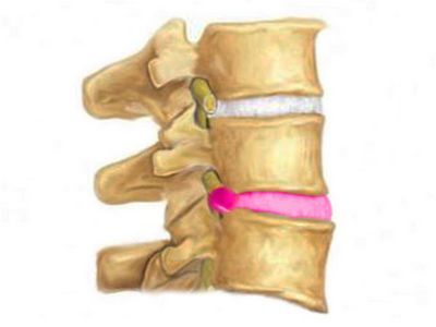 Лечение межпозвоночных грыж в смоленске